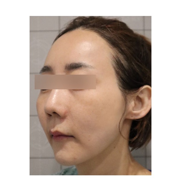 지방이식(풀페이서) 1개월