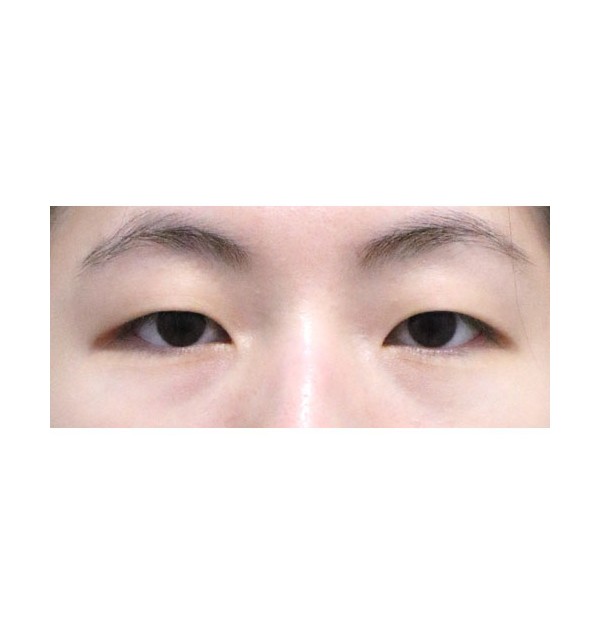 비절개눈매교정 1개월