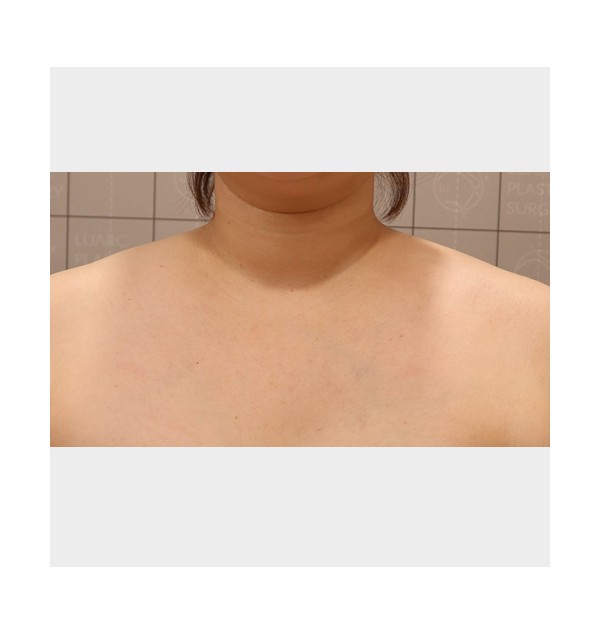 F/35, 목+어깨라인 리노바 한달 후