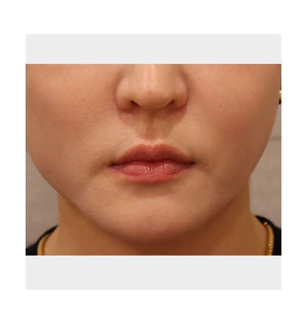 F/37, 실루엣소프트+더블픽스 PDO 리프팅  1주일 후