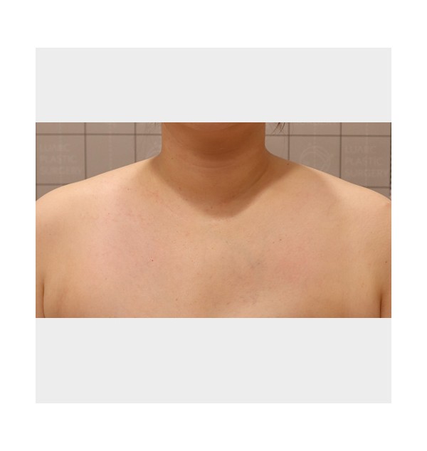 F/35, 목+어깨라인 리노바 한달 후