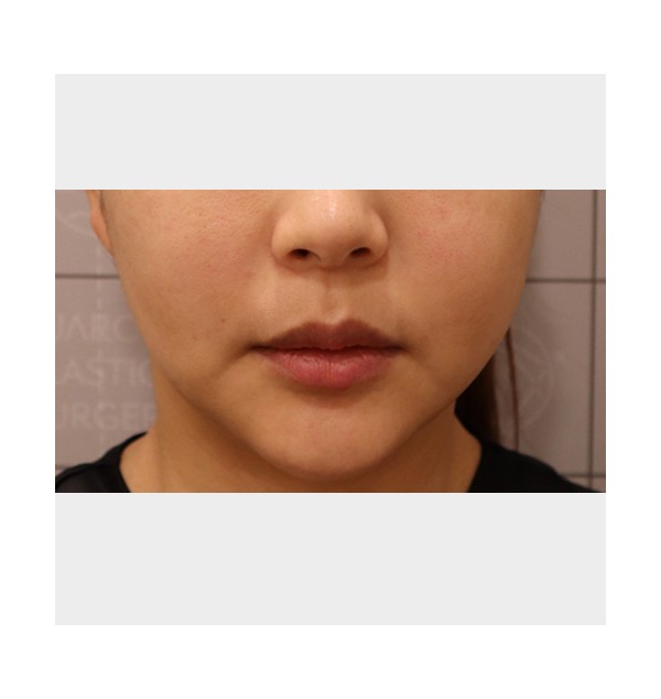 F/37, 더블픽스 PDO 리프팅, 한달 후