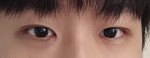 비절개눈매교정+앞트임+뒤밑트임 1개월