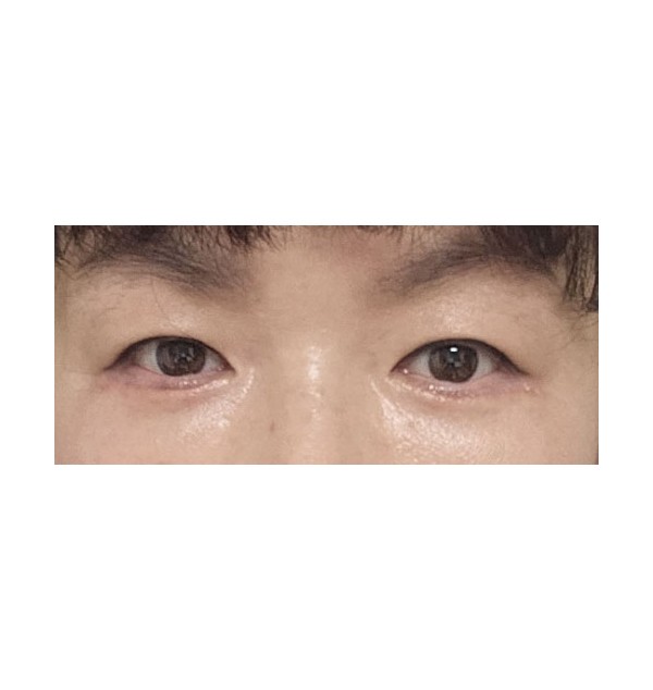 리프팅하안검+눈밑지방재배치 3개월