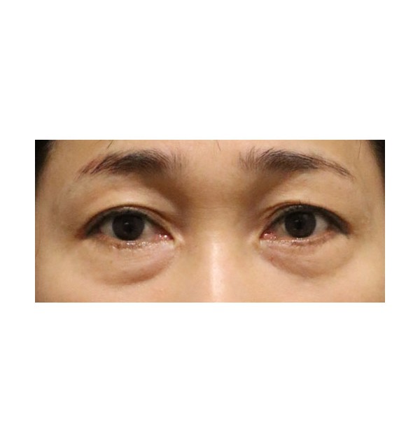 리프팅하안검 3개월