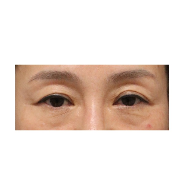 하안검 3개월