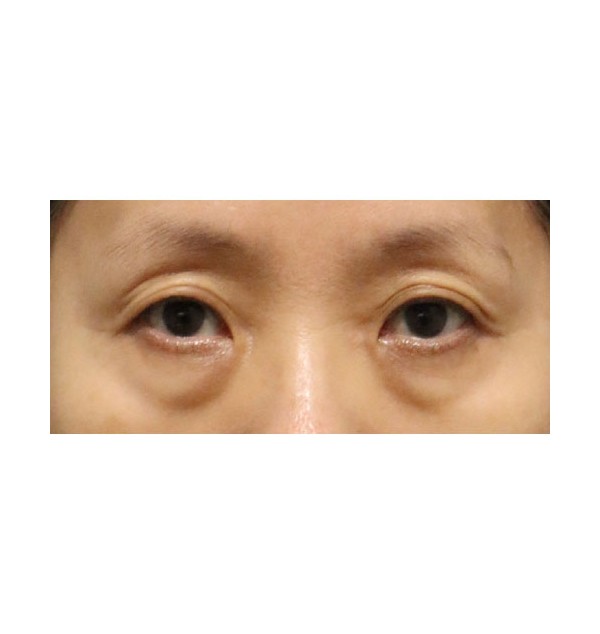 리프팅 하안검 3개월