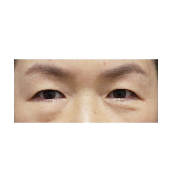 리프팅하안검+눈밑지방재배치 3개월